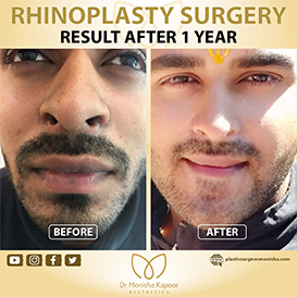 rhinoplasty-img14